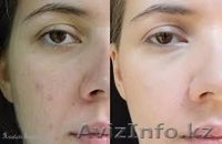 Лечение акне, прыщей, угревой сыпи с алоэ вера - Изображение #2, Объявление #1097373